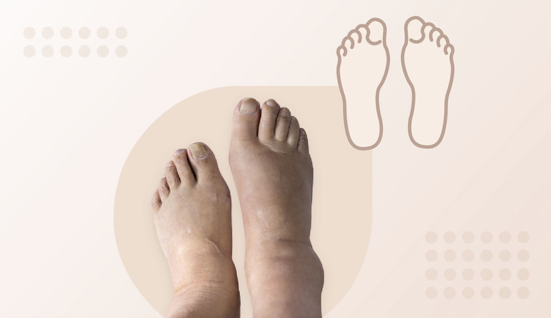 Edema: View Causes, Symptoms and Treatments