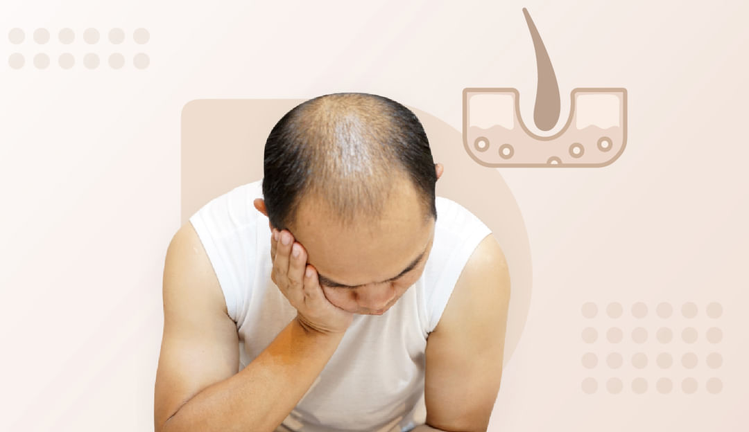 Treating female pattern hair loss - Harvard Health