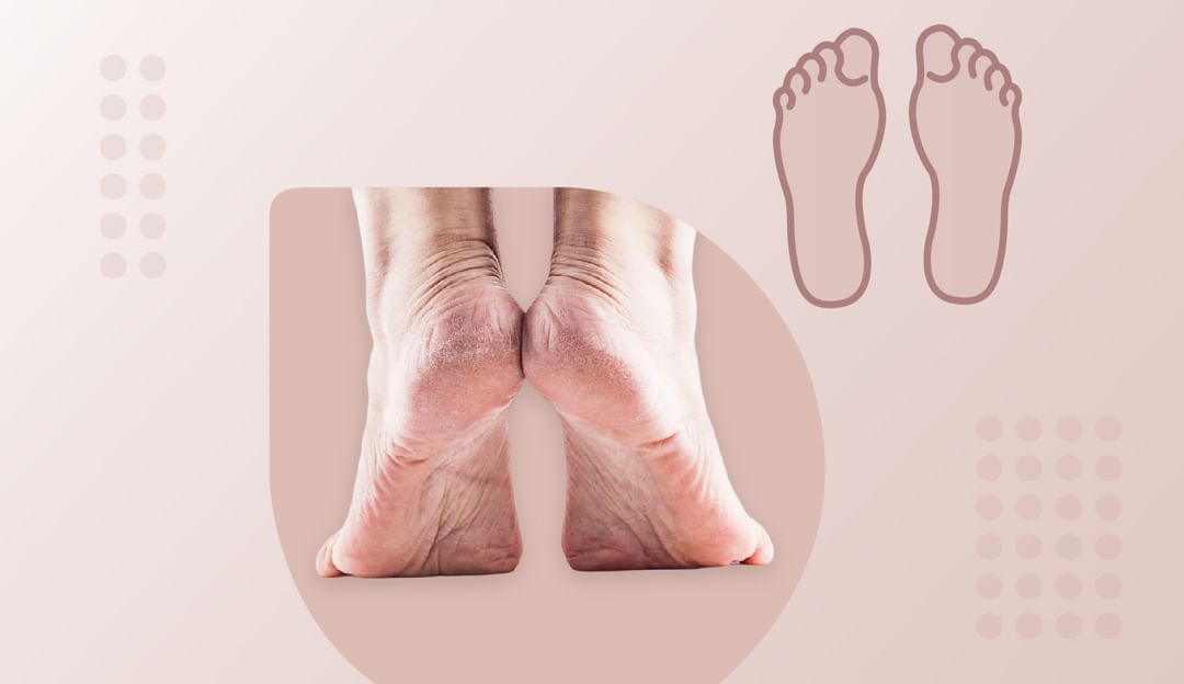 Cracked heels vicks top