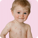 Chickenpox (Varicella)