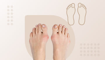 Bunions Bunions