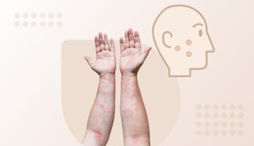 Latex Allergy Latex Allergy