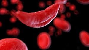 Sickle cell anemia Sickle cell anemia