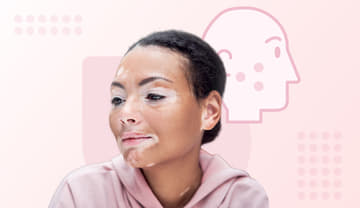 Vitiligo Vitiligo