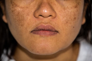 Melasma Melasma
