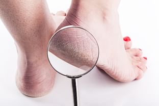 Homoeopathic medicine for cracked heels cheap