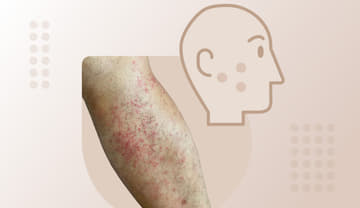 Keratosis pilaris