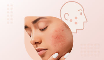 Rosacea