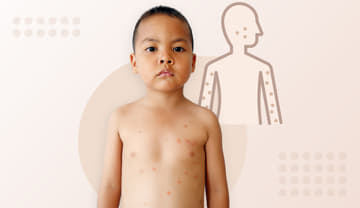 Mpox (Monkeypox) Mpox (Monkeypox)