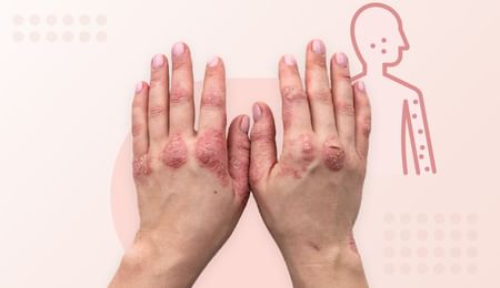 Psoriasis