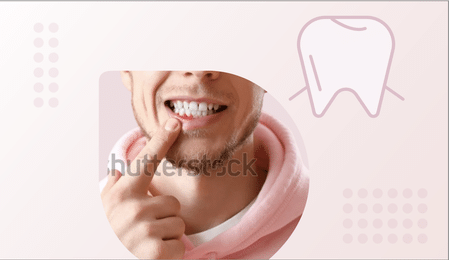 Gingivitis Gingivitis