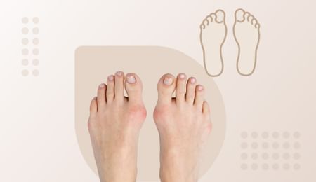 Bunions