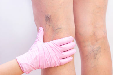 Deep vein thrombosis Deep vein thrombosis