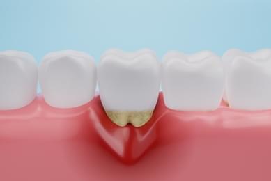 Periodontitis
