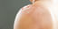 Sunburn