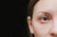 Stye