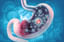 Stomach cancer