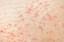 Keratosis pilaris