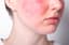 Rosacea