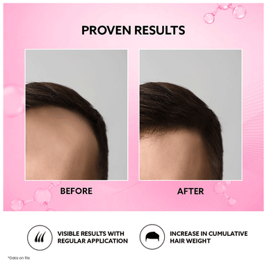 Mintop Forte 2% Hair Restore Formula Solution 60ml