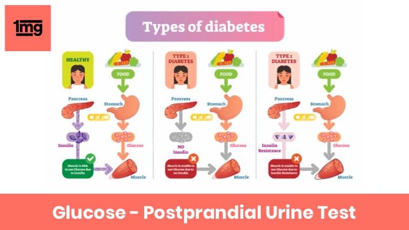 Glucose - Postprandial Urine