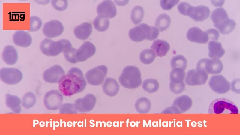 Peripheral Smear for Malaria