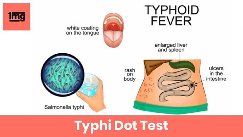 Typhi Dot Salmonella Typhi Igm Purpose Normal Range Of Results 1mg