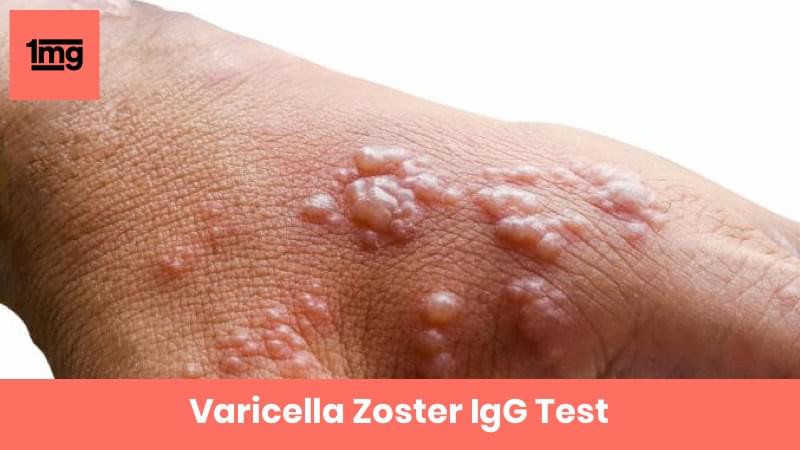 Varicella Zoster IgG