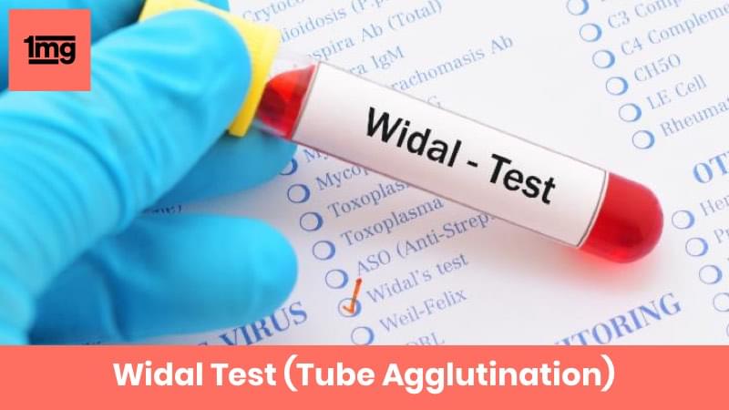 widal-test-tube-agglutination-purpose-normal-range-of-results-1mg