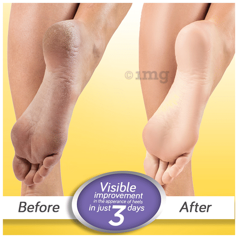 Krack Heel Repair Cream: Buy tube of 25 