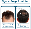 HK Vitals Hairfall Solution Kit Stage 3 thumbnail
