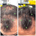 Oziva Combo Pack of Hair Vitamins Capsule (60 Each) thumbnail