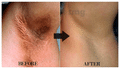 Vedangah Anti Fungal Cream (12gm Each) thumbnail