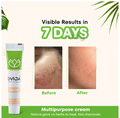 Dvija Skin Cream: Steroid-Free Relief for Fungal Infections, Eczema, Rashes, Itch, Acne & Pimples thumbnail