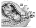 Otica Vacuum Delivery Baby Suction Silicon Cup thumbnail