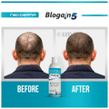 Blogain 5 Minoxidil Topical Solution USP 5% thumbnail