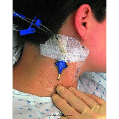 3M Tegaderm 1635 Central I.V. High Secural Dressing
