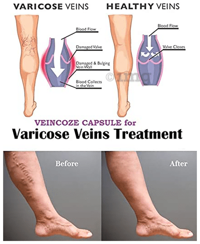 VenaSeal: How 20yo athlete cured his varicose veins