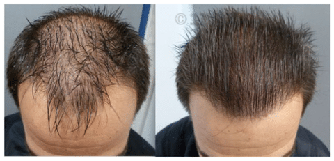 Hair max plus deals minoxidil 5 side effects