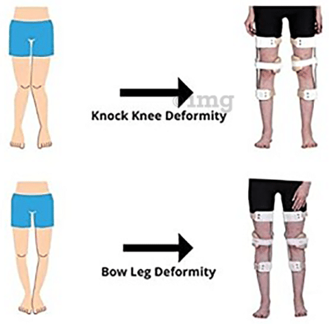 Insoles for knock knees top